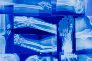 Diferències entre artritis i artrosis